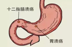 消化性溃疡,病因、症状与治疗概览